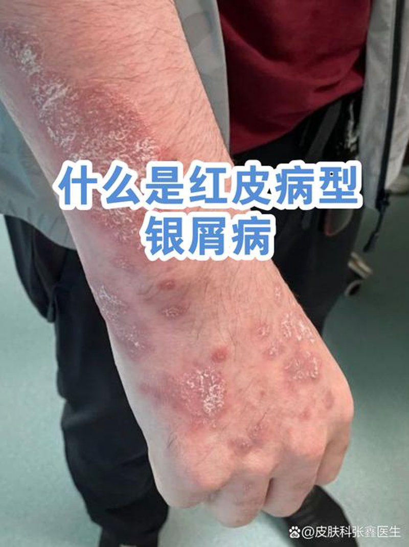 牛皮癣能治好吗：探寻治疗之路