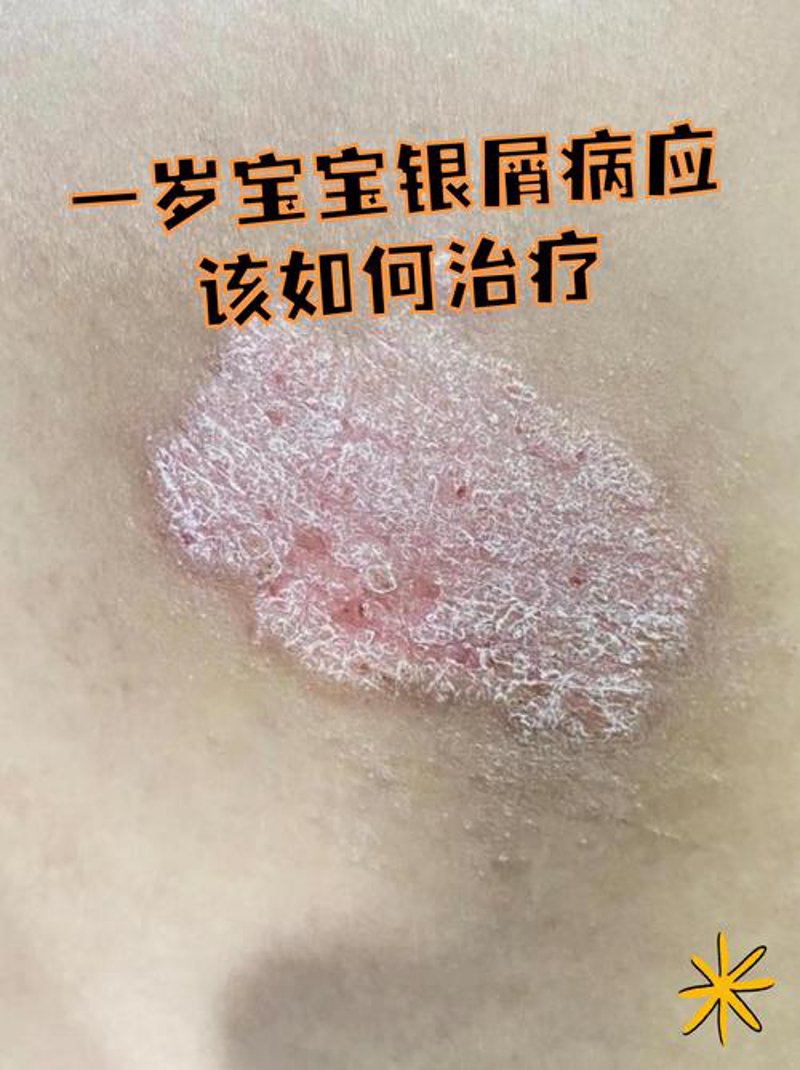 牛皮癣医院的治疗进展与前沿
