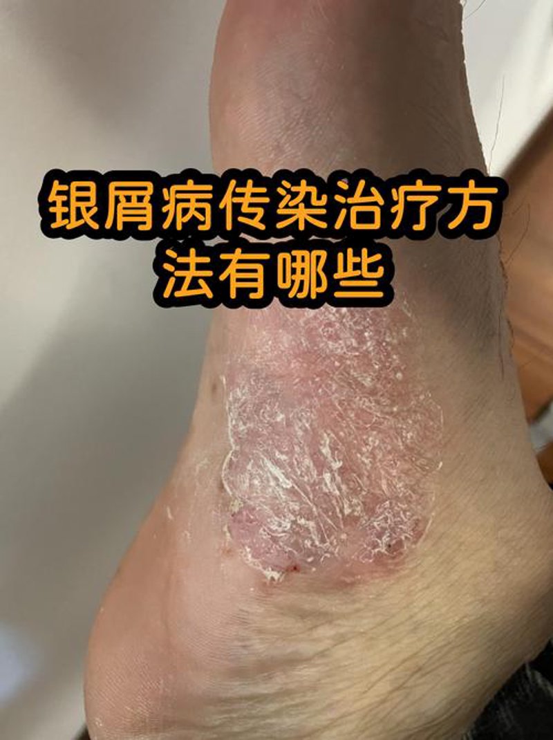 银屑病治疗：新进展与挑战