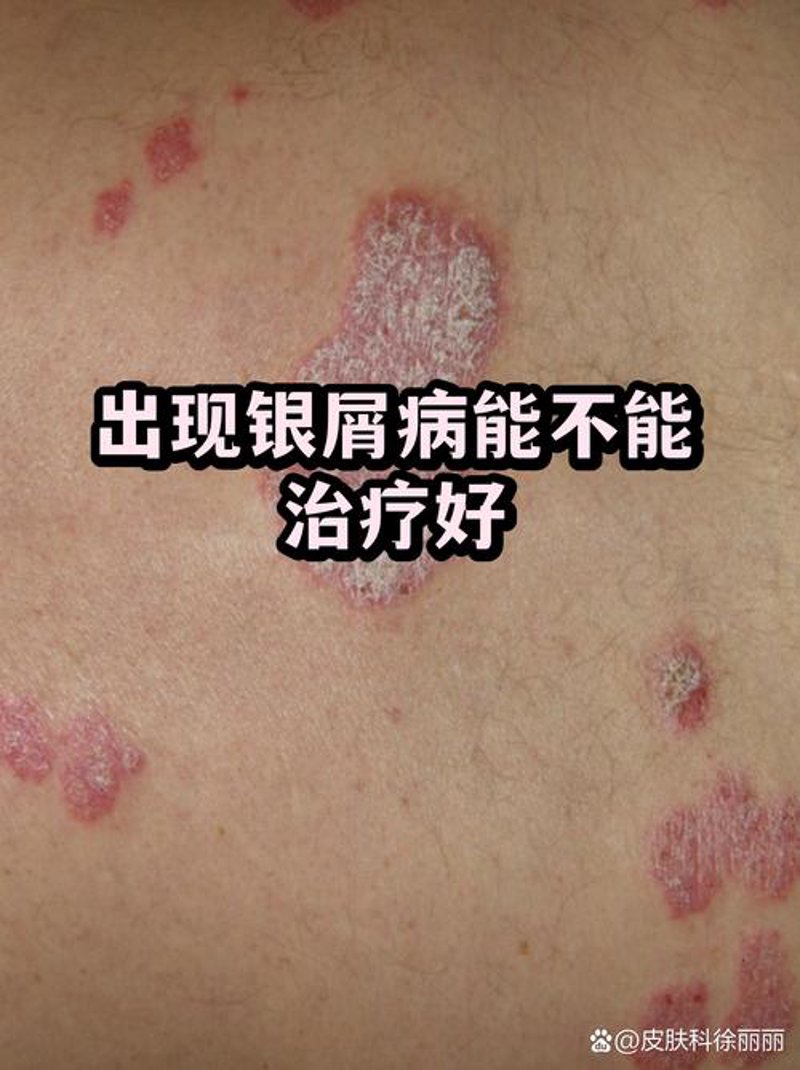 牛皮癣医院：寻找健康的春天