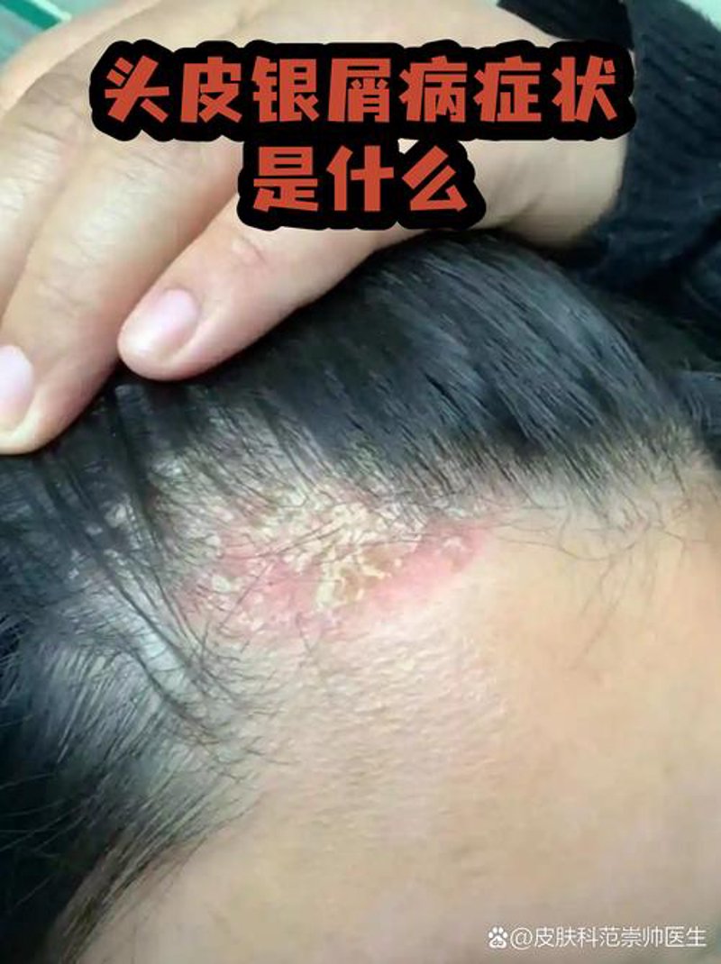 银屑病治疗：最新进展及趋势