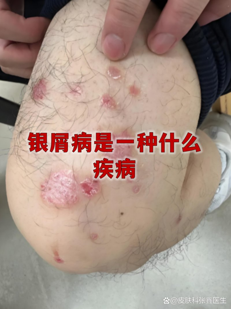 科学祛除银屑病：新疗法展现希望