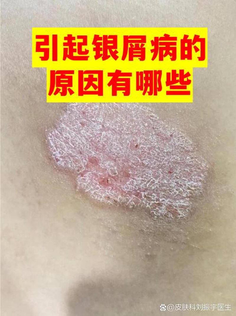 银屑病偏方