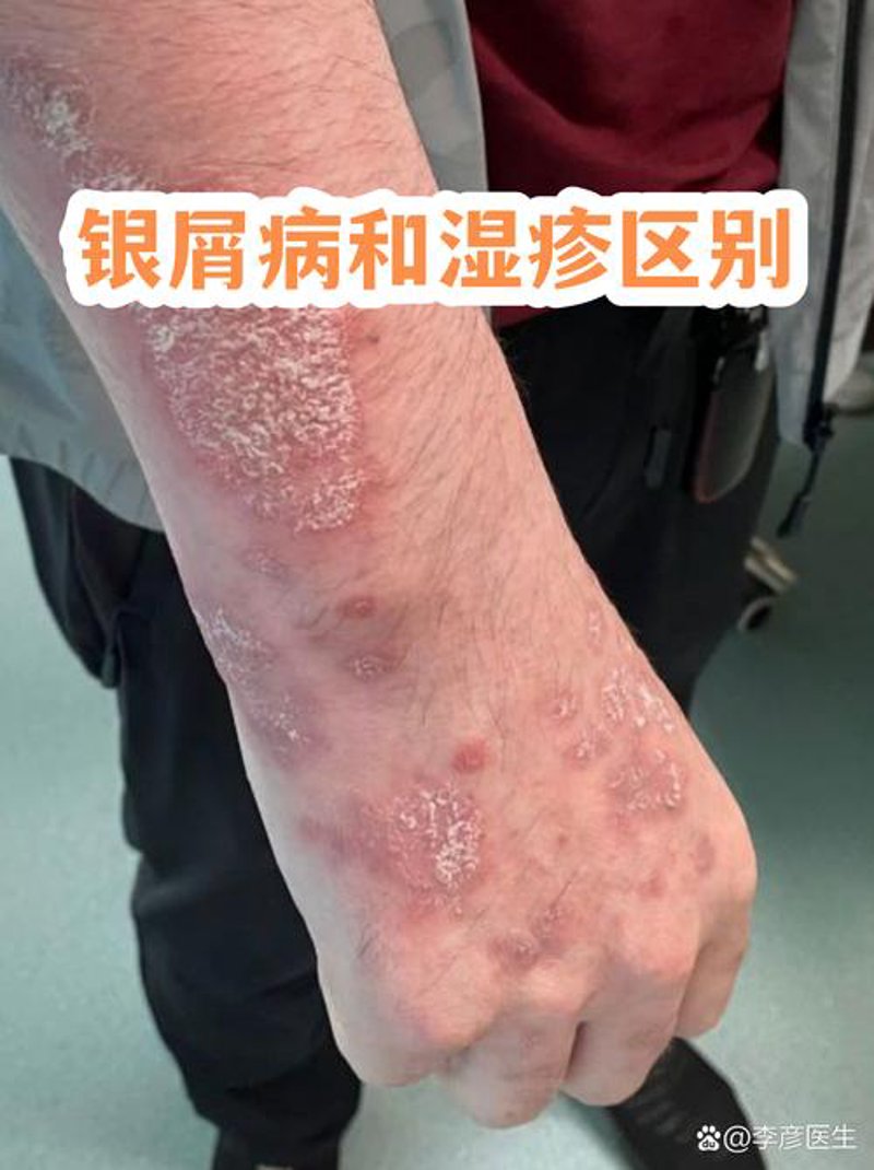 银屑病专家
