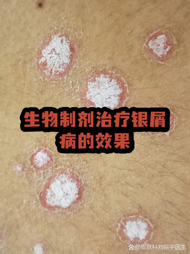 牛皮癣医院：最新的医疗进展与治疗趋势
